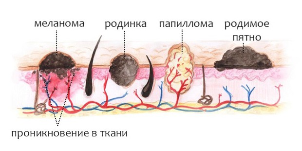 birthmark