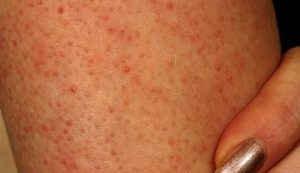 keratosis-pilaris-pictures-2