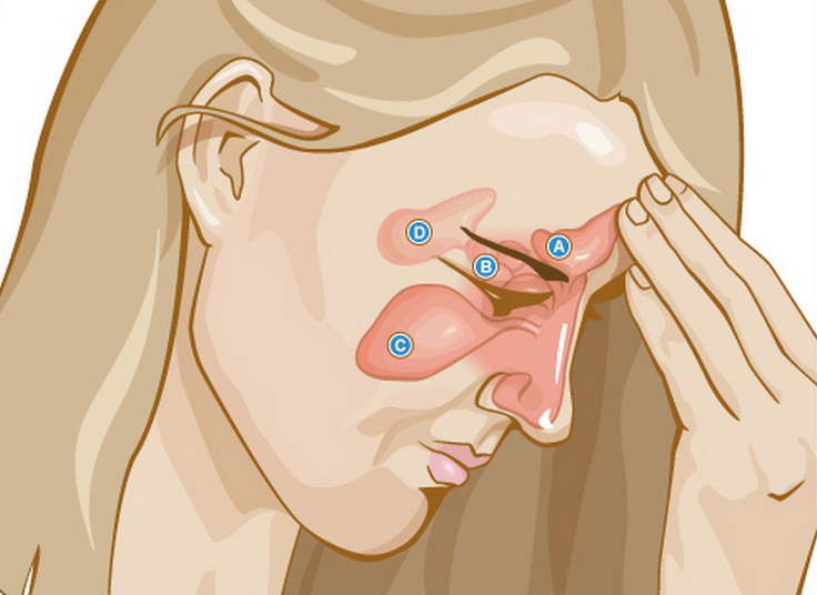 natural-remedies-sinus