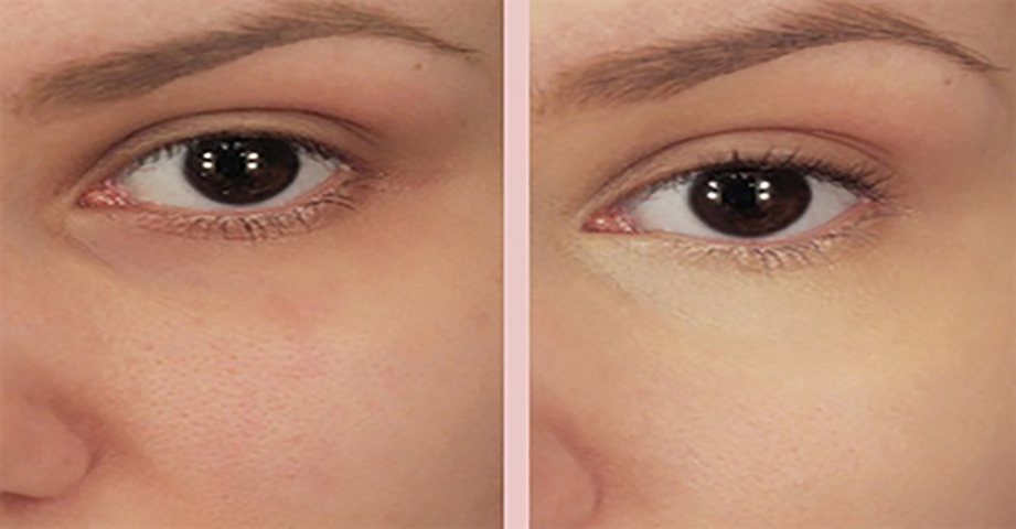 Она нанесла немного соды под глаза, и получила замечательный результат!