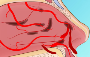 Ковыряние в носу может привести к хроническому воспалению!