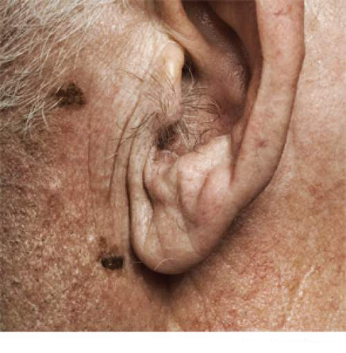 3 простых средства для избавления от волос в ушах!