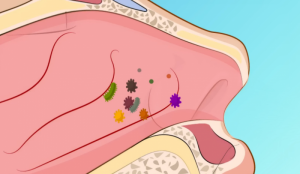 Ковыряние в носу может привести к хроническому воспалению!