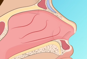 Ковыряние в носу может привести к хроническому воспалению!