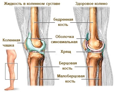 Жидкость в коленном суставе? Смотрите простейший способ избавиться от нее! 