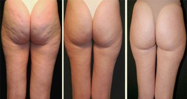 100% натуральный чудесный рецепт, чтобы избавиться от целлюлита !!!